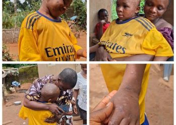 10-Year-Old Scalded by Guardians Leaves Anambra Hospital Fully Healed