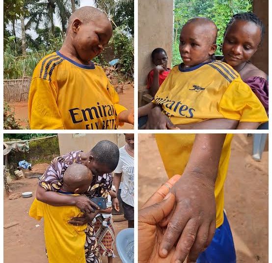 10-Year-Old Scalded by Guardians Leaves Anambra Hospital Fully Healed