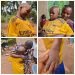10-Year-Old Scalded by Guardians Leaves Anambra Hospital Fully Healed